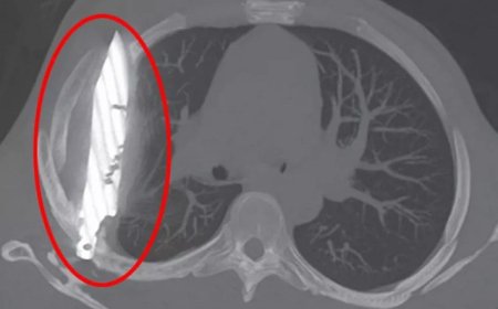 Tanzaniyada kişi xəbəri olmadan səkkiz il sinəsində bıçaqla yaşayıb