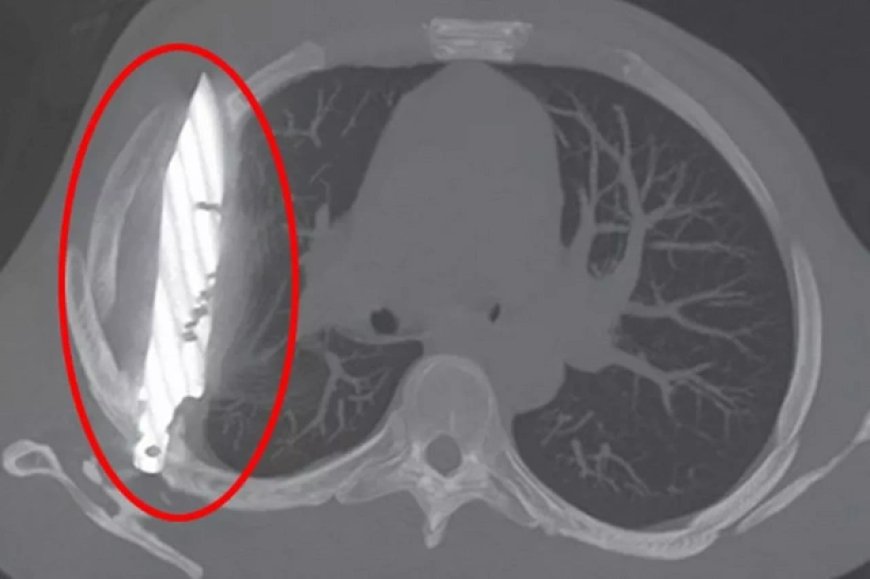Tanzaniyada kişi xəbəri olmadan səkkiz il sinəsində bıçaqla yaşayıb