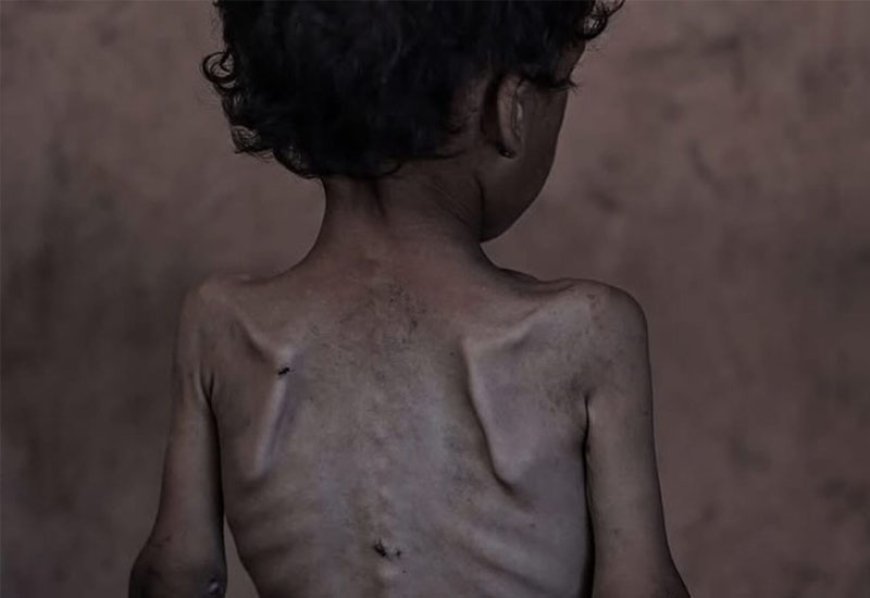 Qəzzada aclıq qurbanlarının sayı artır – SON STATİSTİKA